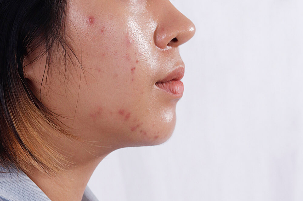 Beauty Queen Beauty Parlour acne prone